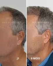 Clinique d’implants capillaires à Charleroi
