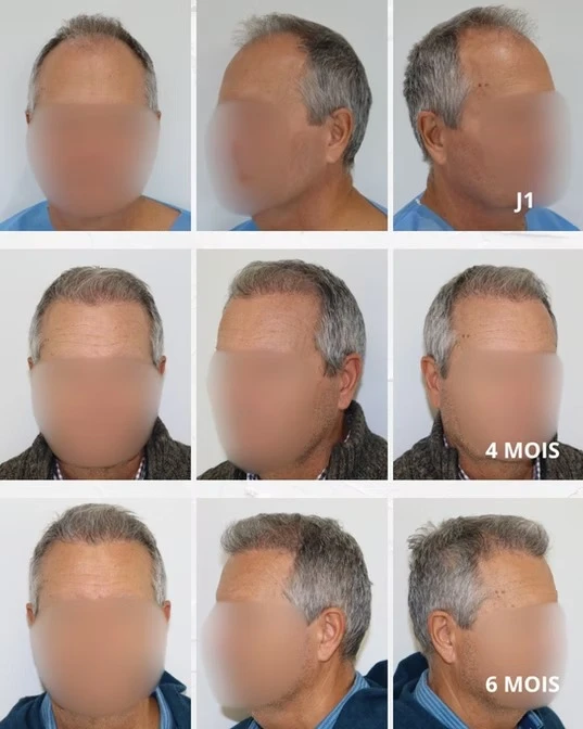 Clinique de transplantation capillaire à Charleroi