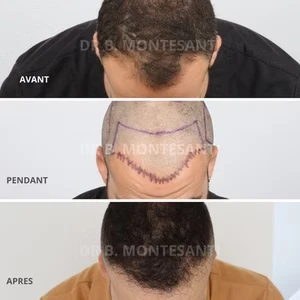 Différence entre FUE et FUT pour une greffe de cheveux