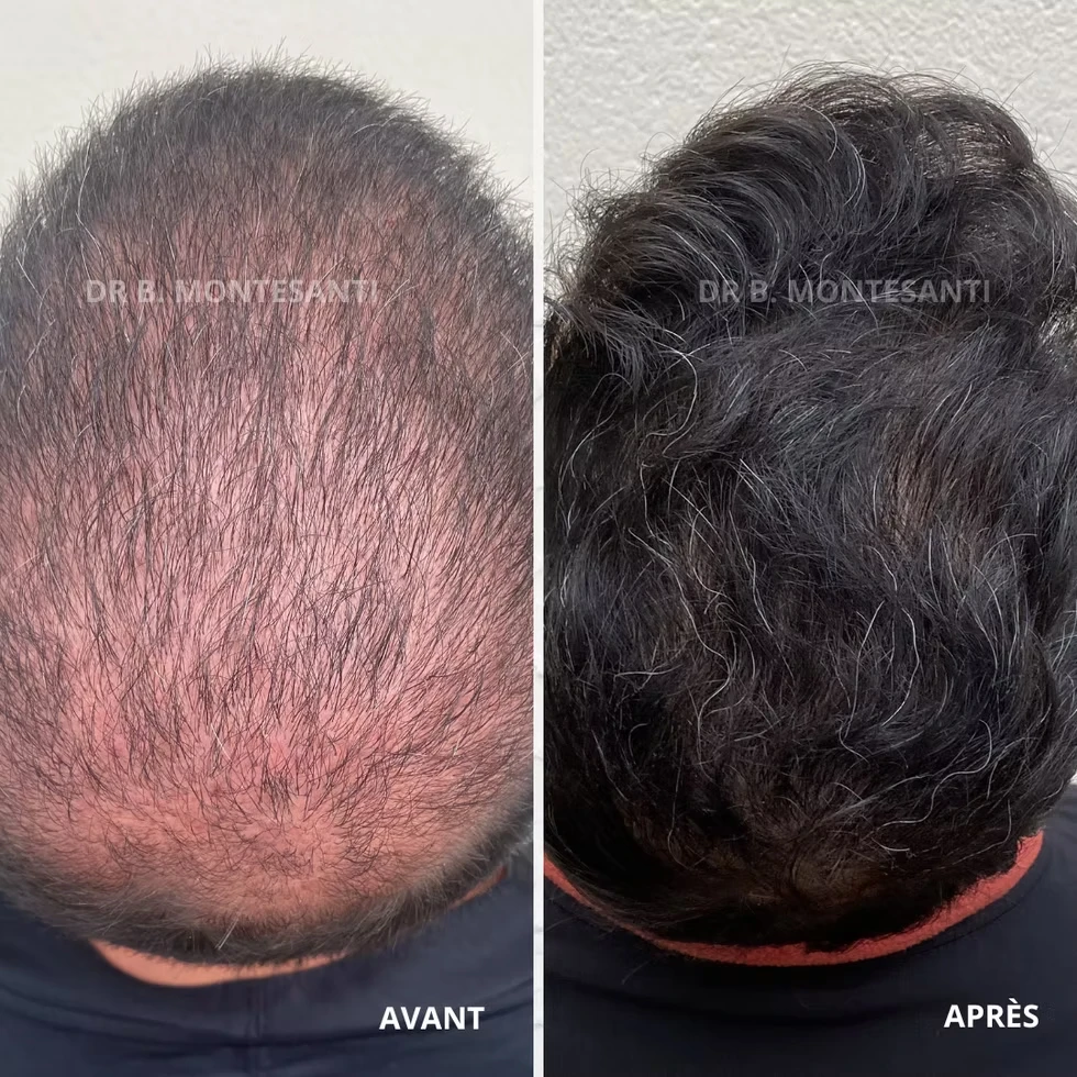 Résultat discret de greffe de cheveux naturelle