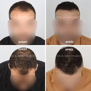 Implants capillaires en Belgique à Charleroi
