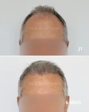 Meilleure clinique de greffe de cheveux en Belgique