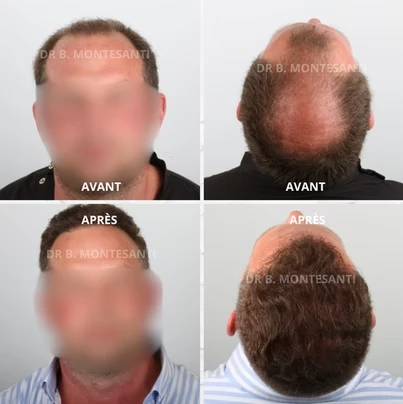 Spécialiste de la greffe de cheveux à Charleroi